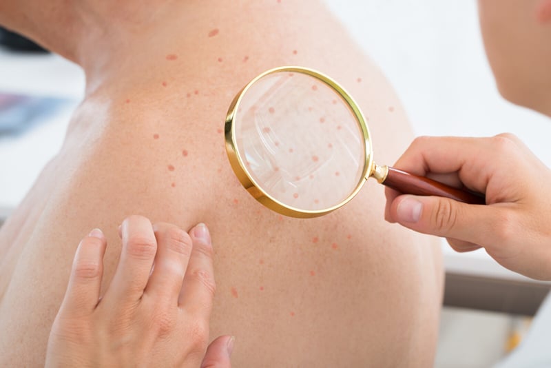 Read more about the article Actinic Keratosis – Coding, Billing and Clinical Information